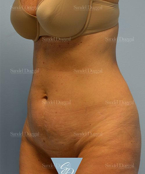 Tummy Tuck before, case 1599