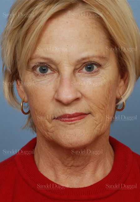 Laser Skin Resurfacing before, case 2692