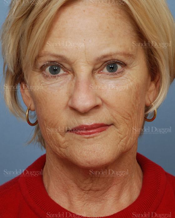 Laser Skin Resurfacing before, case 2692