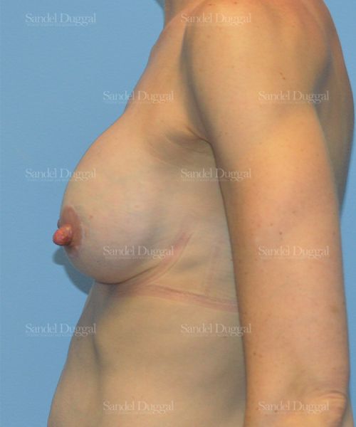 Breast Augmentation with Lift after, case 3400