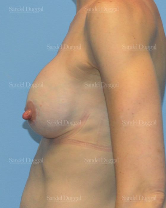 Breast Augmentation with Lift after, case 3400