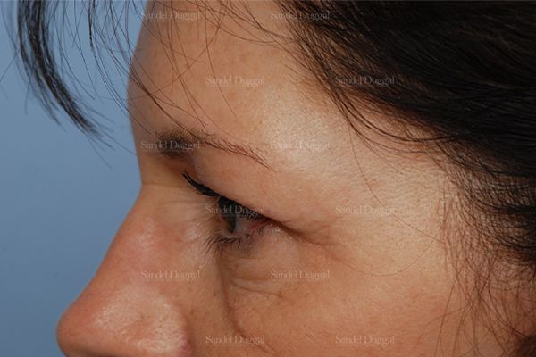 Eyelid Rejuvenation before, case 1960