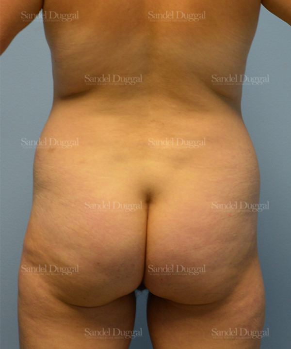 Liposuction — Legs & Flanks before, case 2512