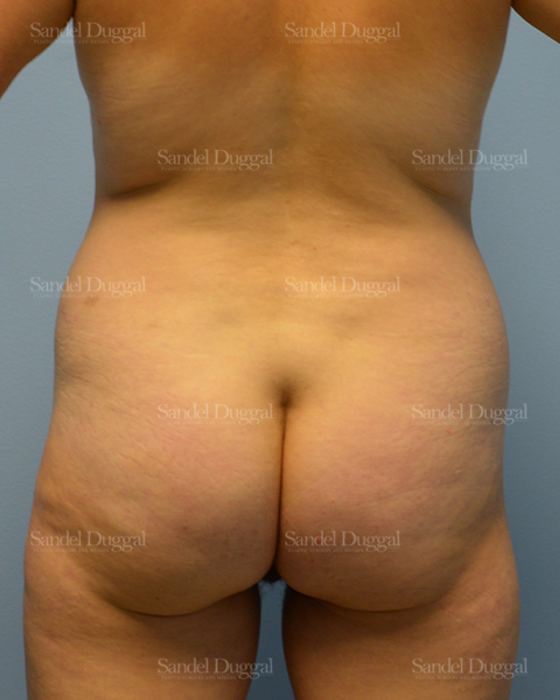 Liposuction — Legs & Flanks before, case 2512