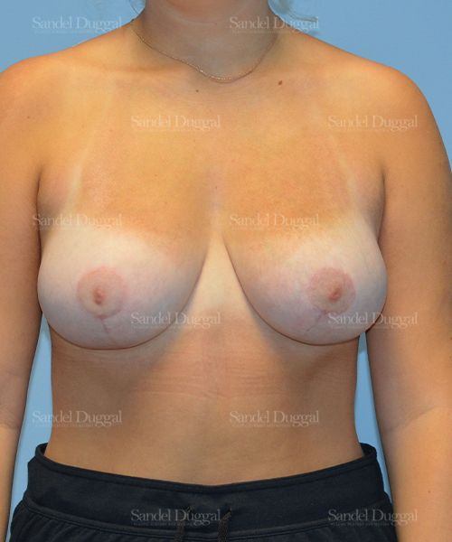Breast Lift after, case 3301