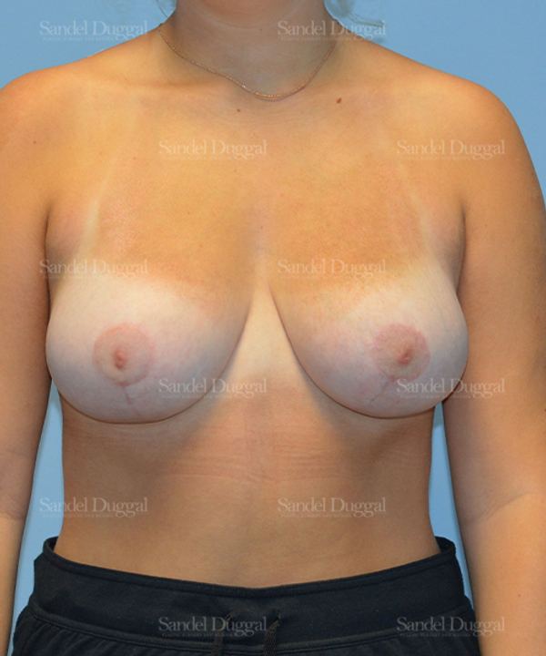 Breast Lift after, case 3301