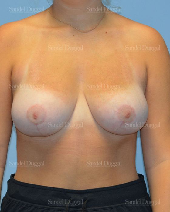 Breast Lift after, case 3301