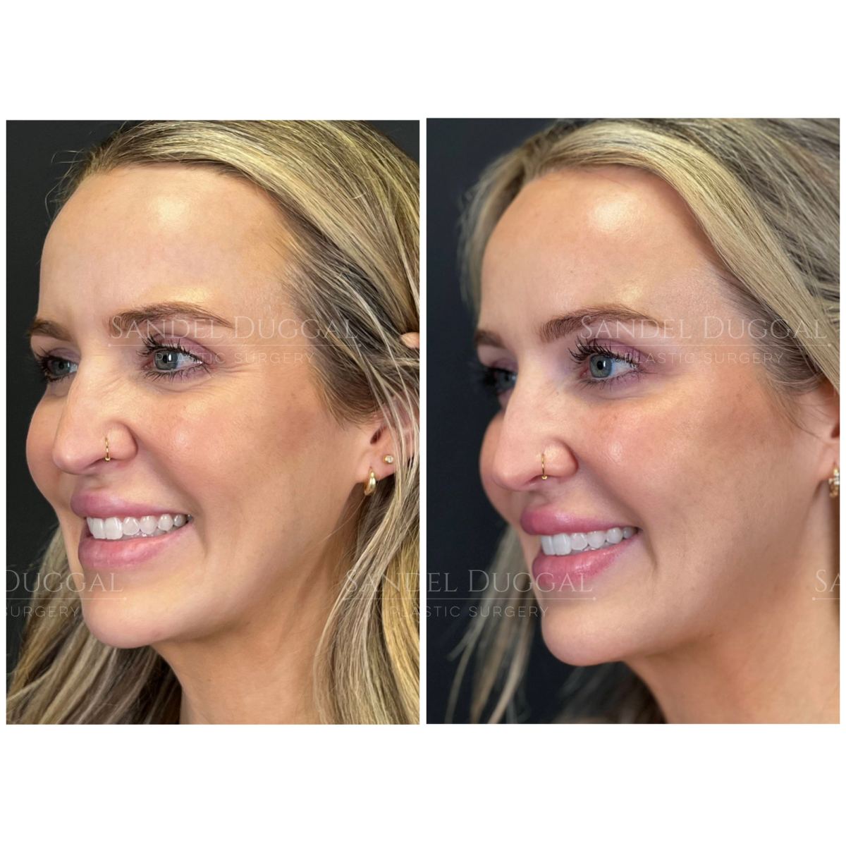 Botox & Fillers before and after, case 6011