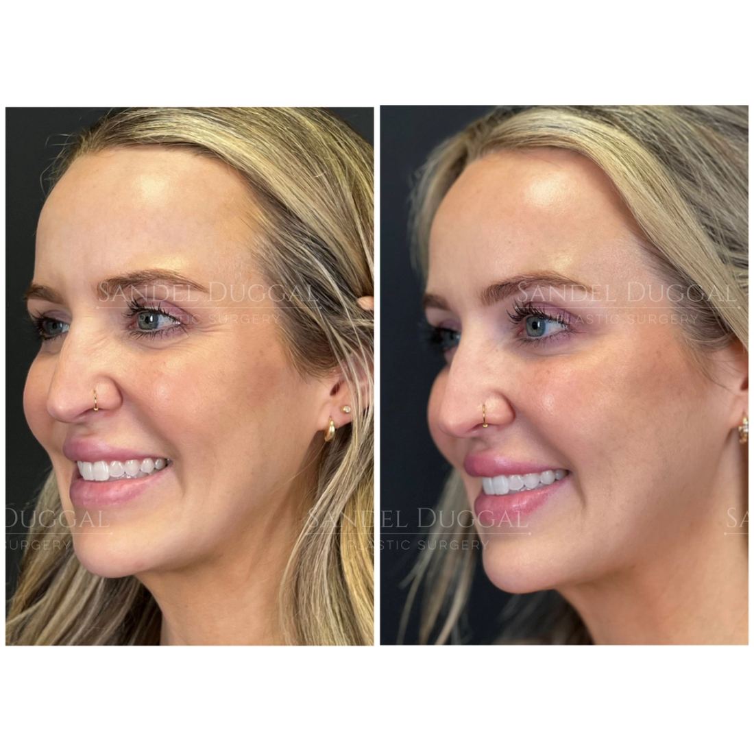 Botox & Fillers before and after, case 6011