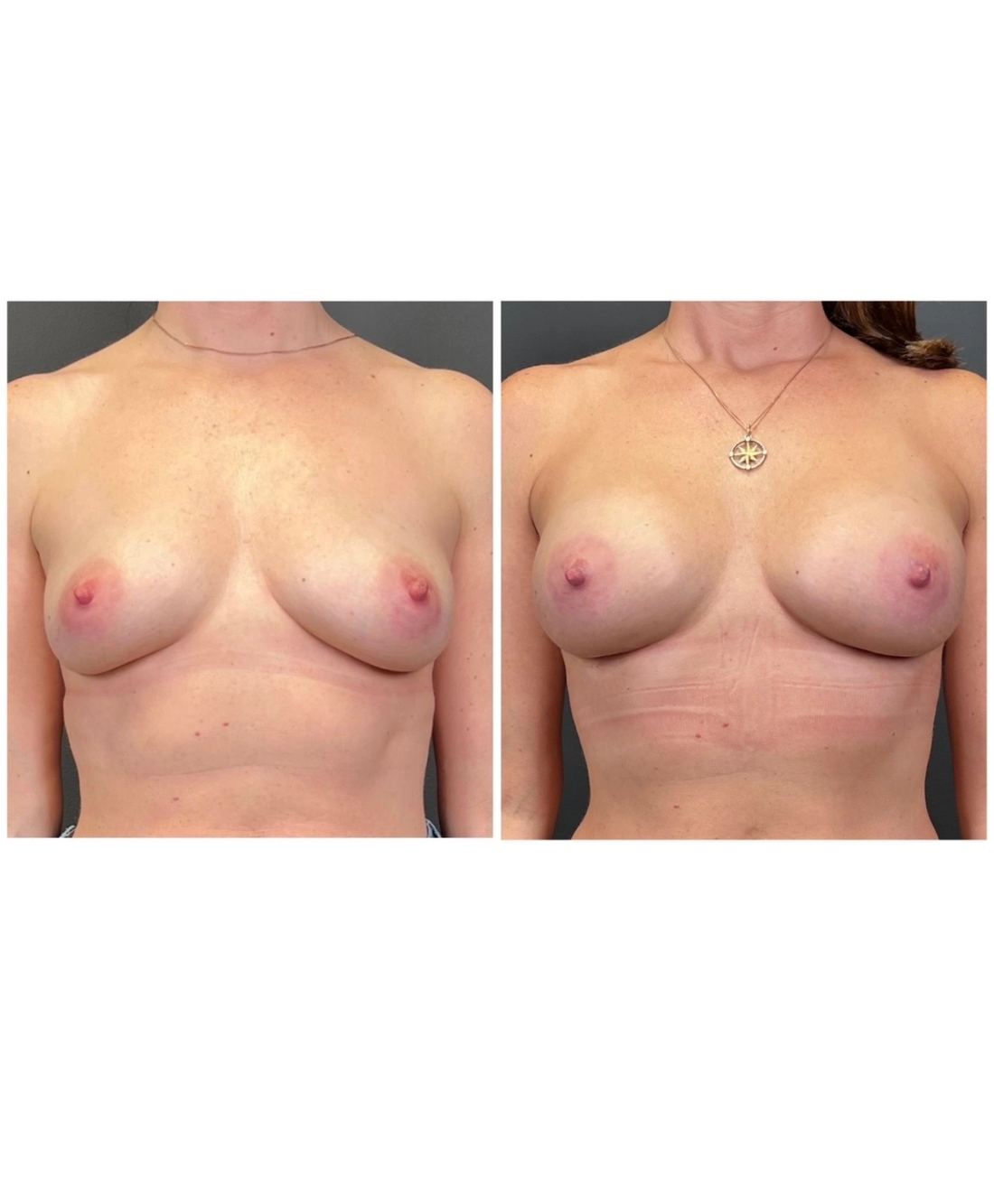 Motiva Preserve before and after, case preserve-01