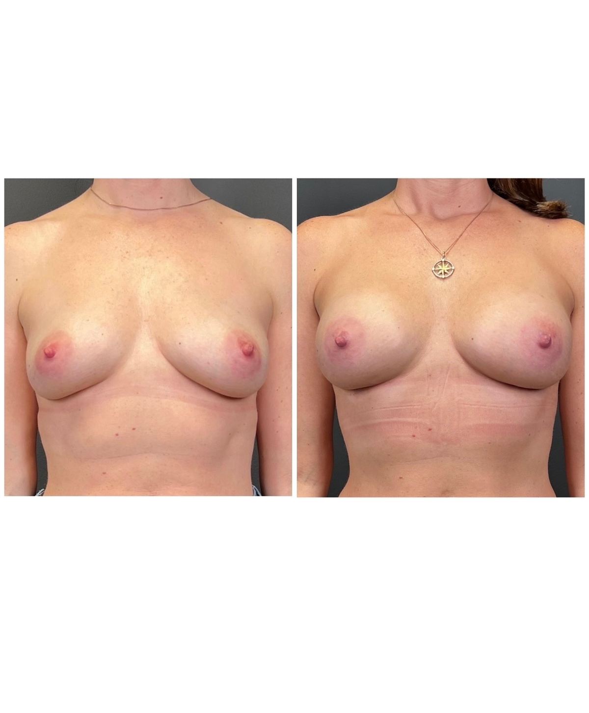 Motiva Preserve before and after
