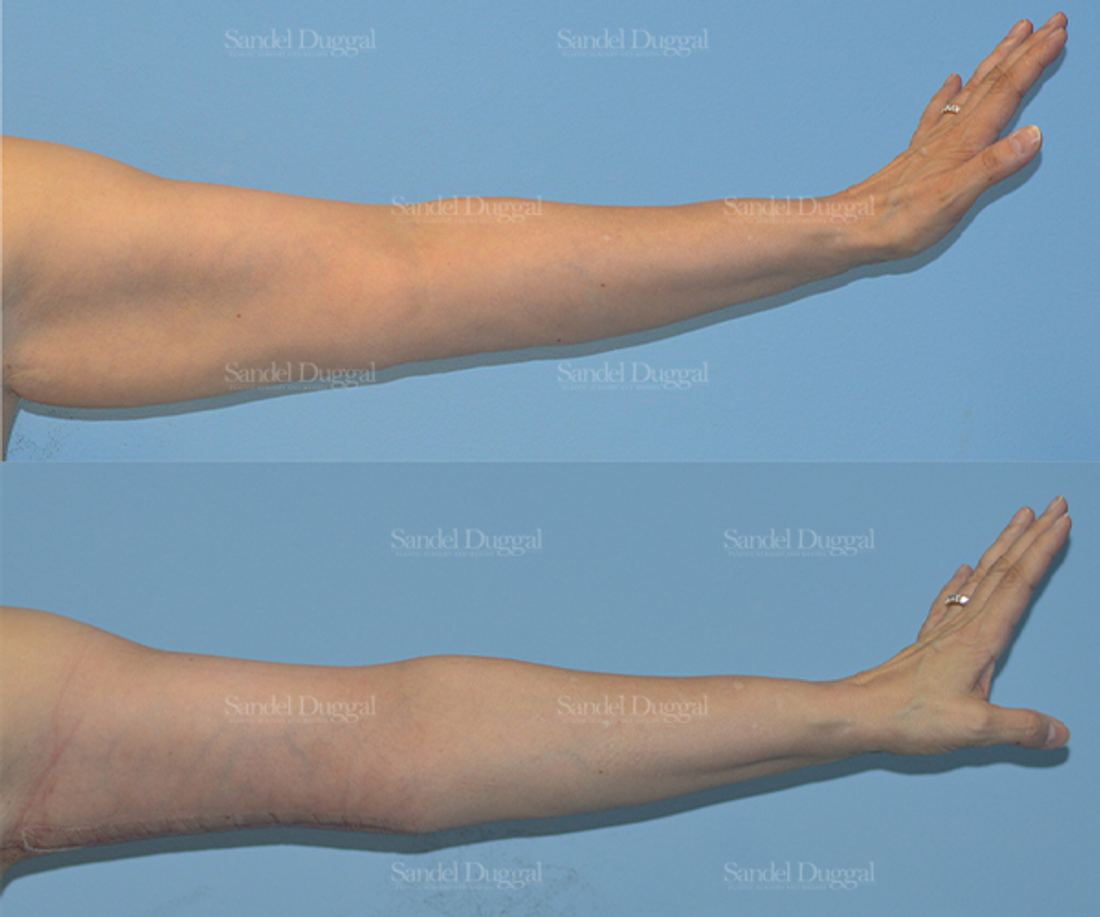 Brachioplasty before and after, case 2103