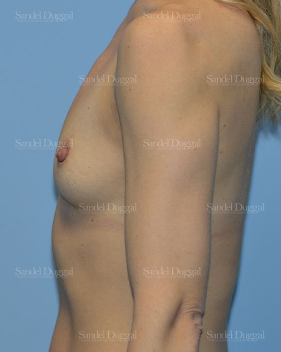Breast Augmentation before, case 3199