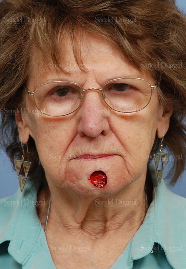 Reconstruction after Mohs before, case 2730