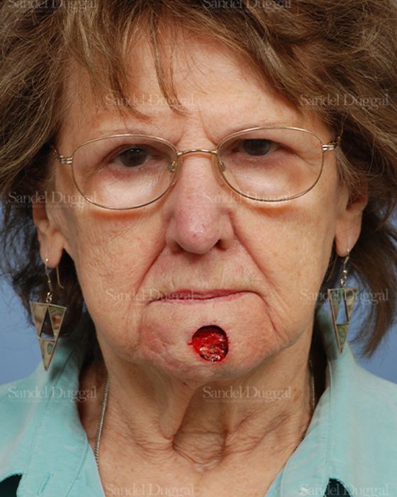 Reconstruction after Mohs before, case 2730