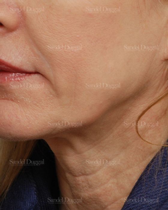 Mini Facelift before, case 2582
