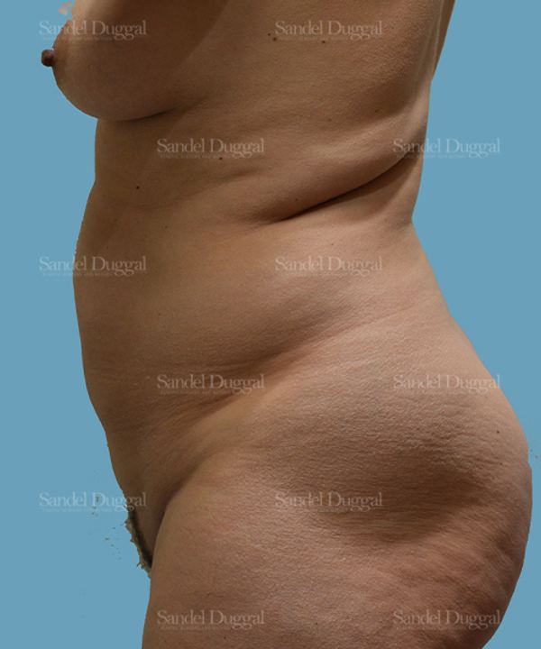 Tummy Tuck before, case 1526