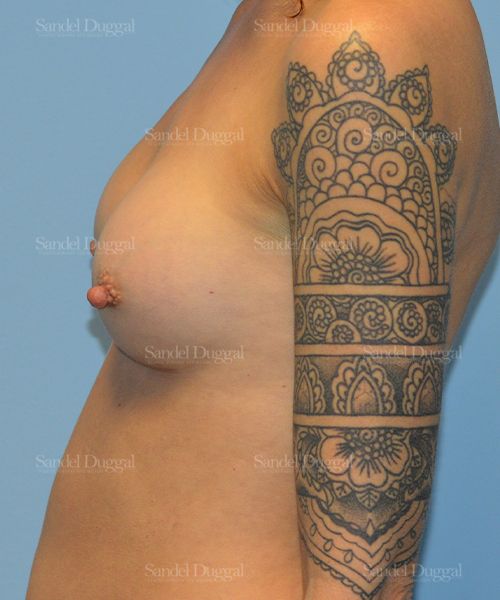 Breast Augmentation after, case 3136