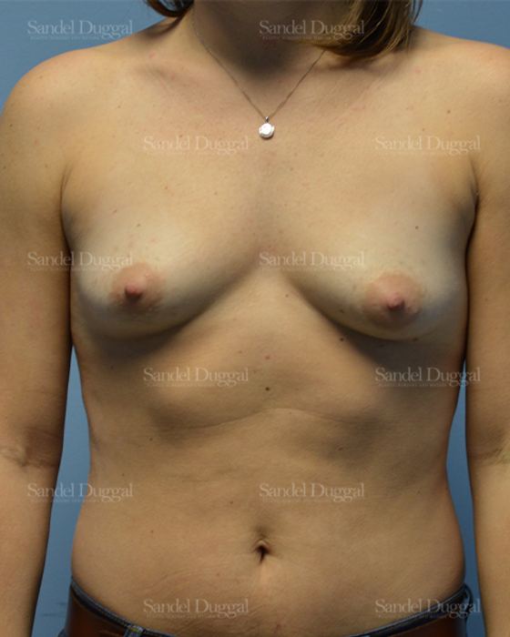 Breast Augmentation before, case 3213