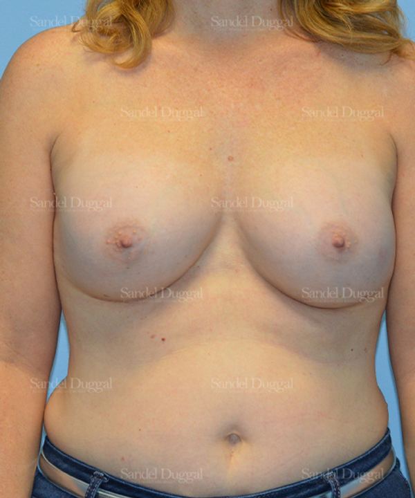 Breast Augmentation after, case 3094