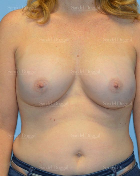 Breast Augmentation after, case 3094