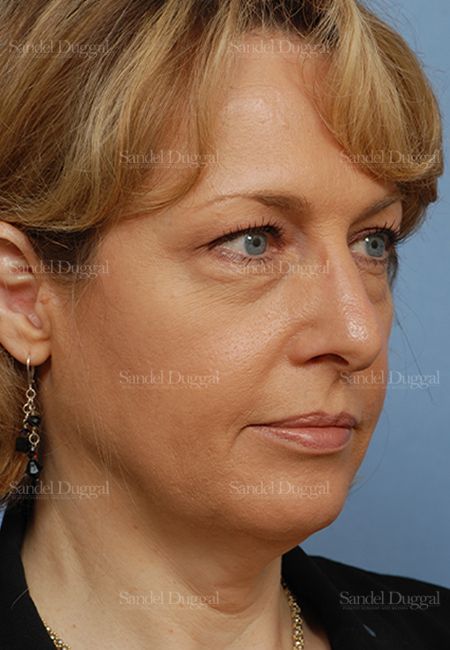 Facelift before, case 806
