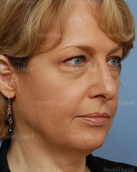 Facelift before, case 806
