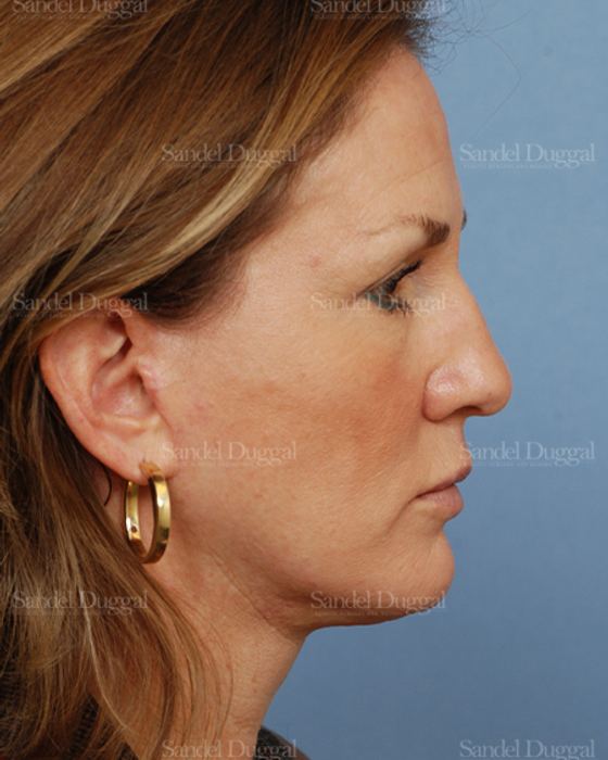 Facelift after, case 2685