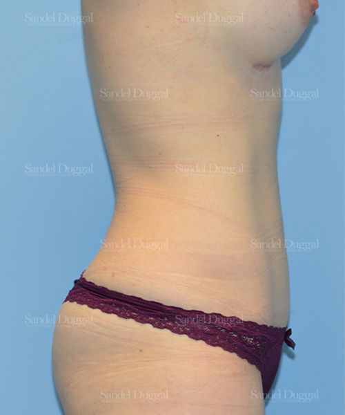 Tummy Tuck after, case 1554
