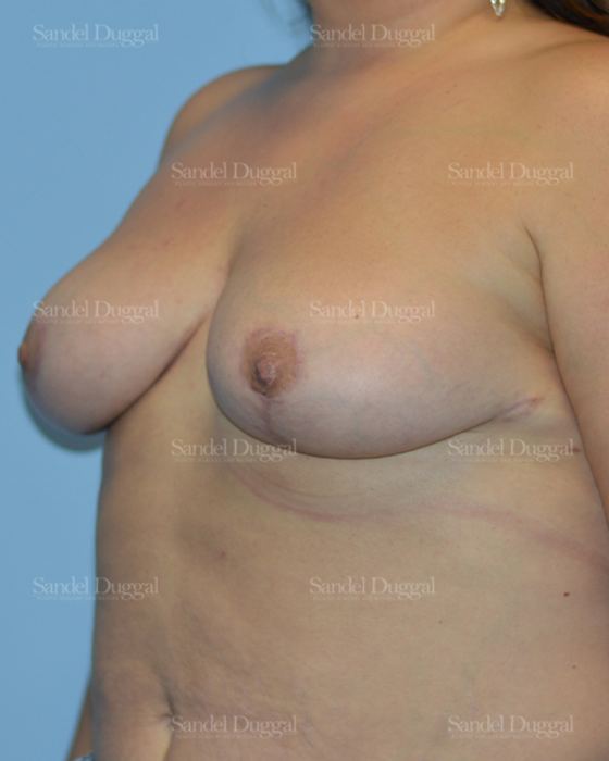 Breast Lift after, case 3280