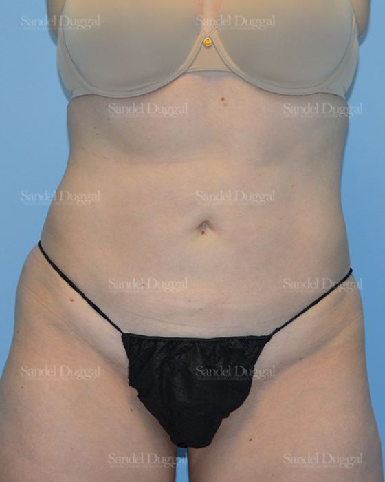 Liposuction — Abdomen after, case 2469