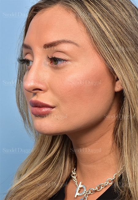Non-Surgical Rhinoplasty after, case 5369