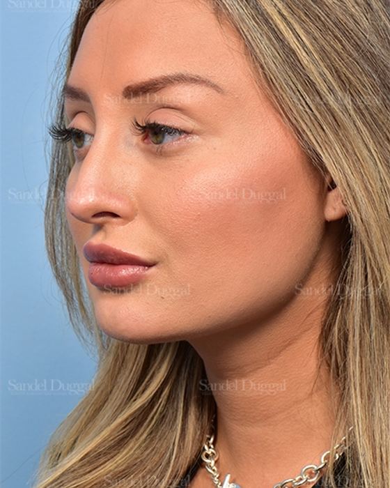 Non-Surgical Rhinoplasty after, case 5369