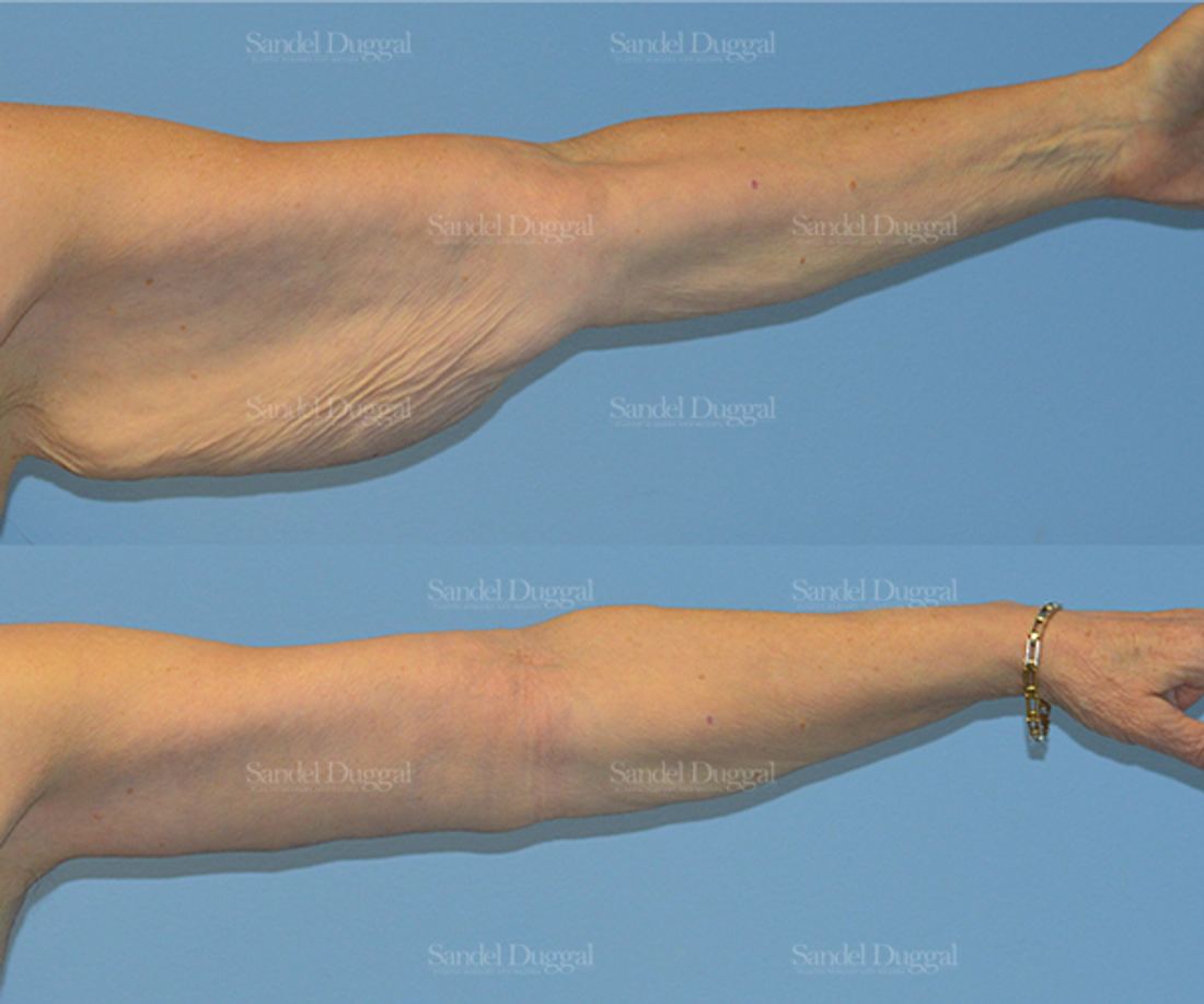 Brachioplasty before and after, case 2150