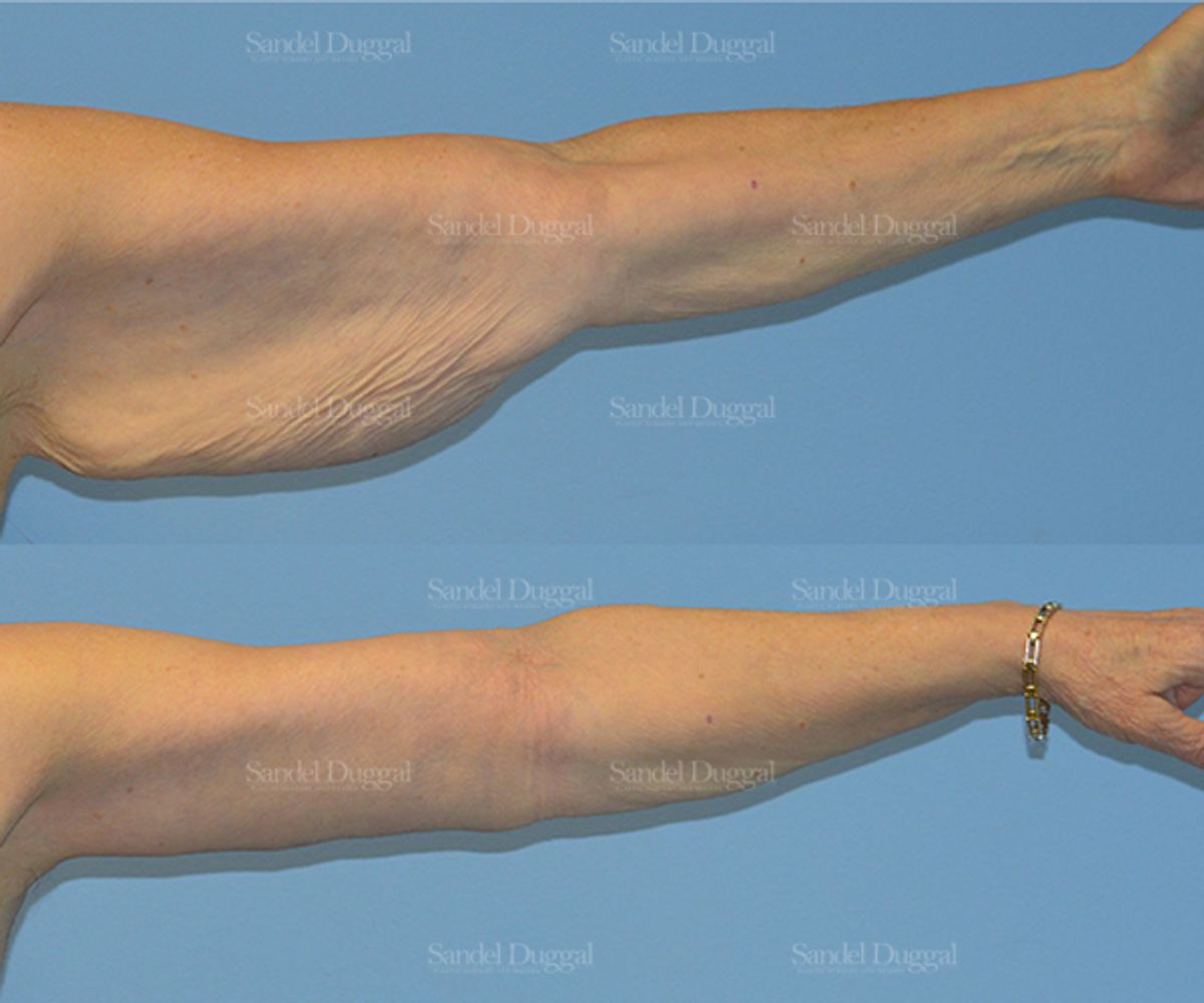 Brachioplasty before and after, case 2150