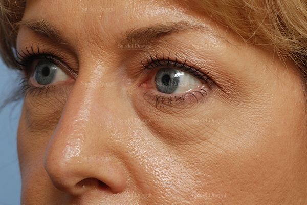 Eyelid Rejuvenation before, case 824