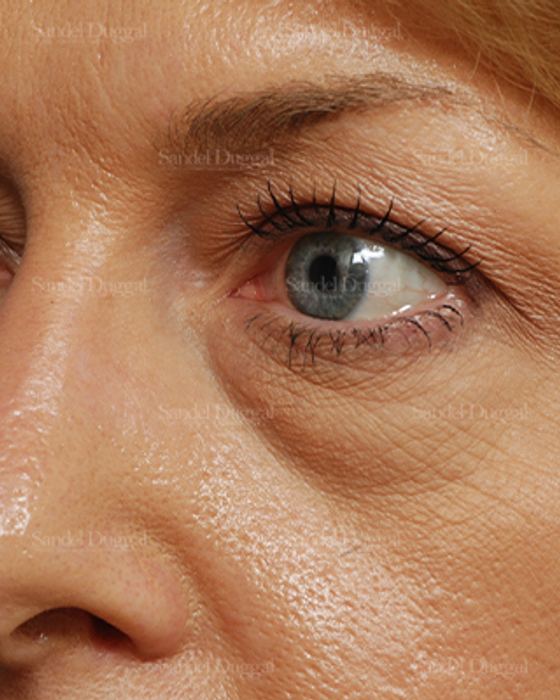 Eyelid Rejuvenation before, case 824