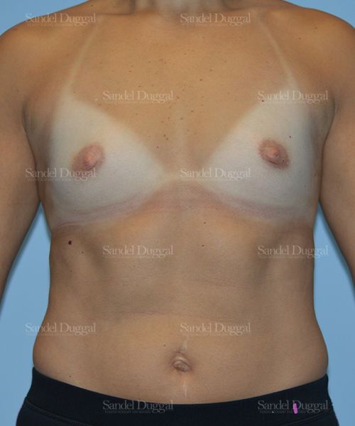 Breast Augmentation before, case 3143