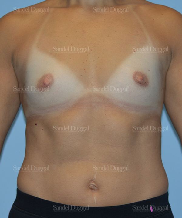 Breast Augmentation before, case 3143