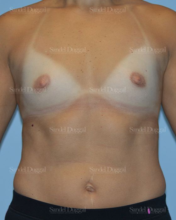 Breast Augmentation before, case 3143