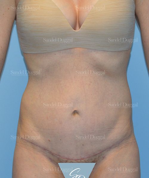 Tummy Tuck after, case 1652