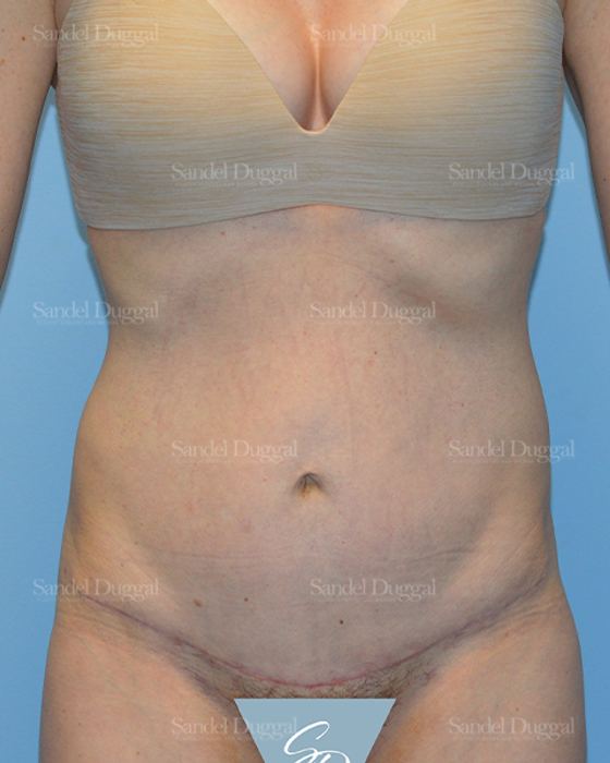 Tummy Tuck after, case 1652
