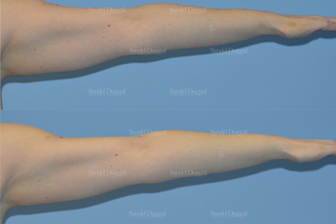 Liposuction — Arms before and after, case 2487