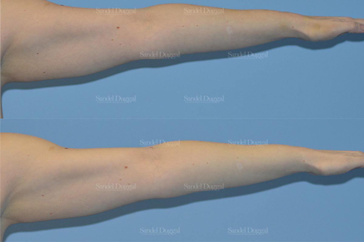 Liposuction — Arms before and after, case 2487