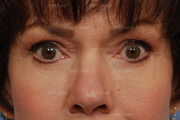 Eyelid Rejuvenation after, case 1971