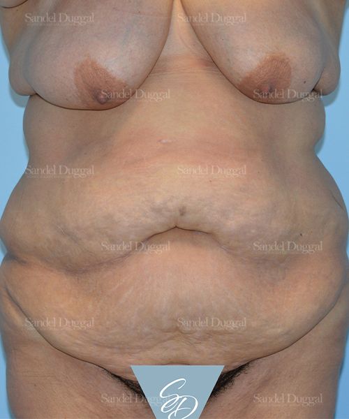 Tummy Tuck before, case 1547