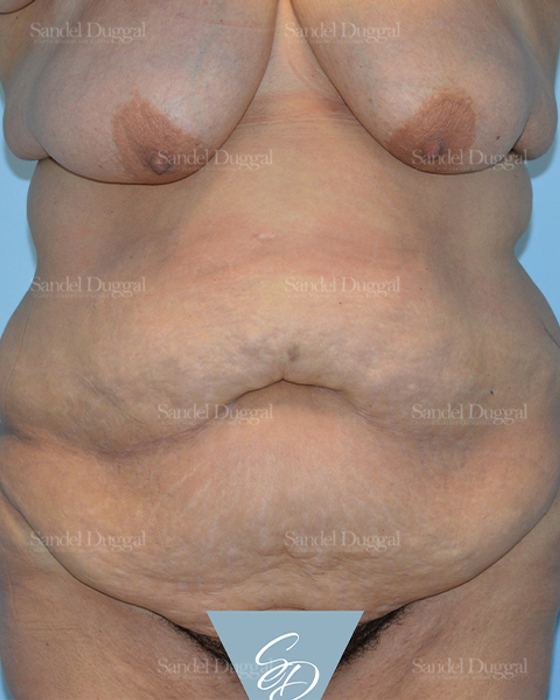 Tummy Tuck before, case 1547