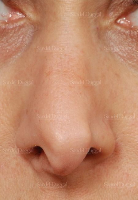 Revision Rhinoplasty before, case 2624