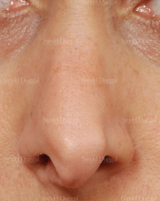 Revision Rhinoplasty before, case 2624
