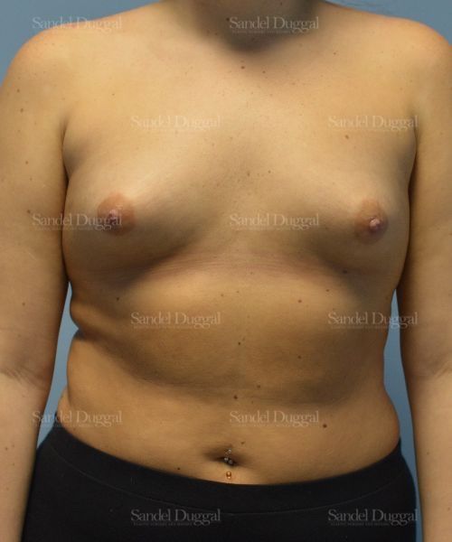 Breast Augmentation before, case 4756